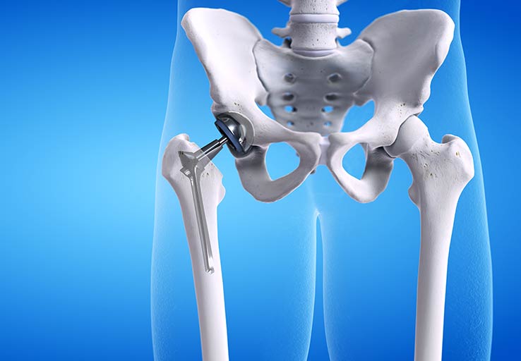 Orthopaedic hip implant
